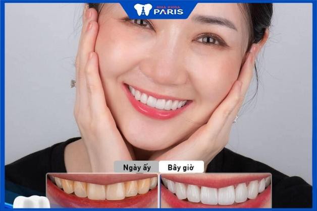 Khách hàng trước và sau khi dán răng sứ Nha Khoa Paris tại Đà Nẵng