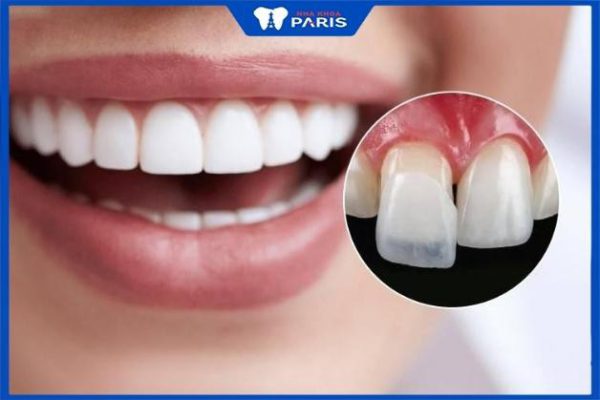 3 Kinh nghiệm dán răng sứ Veneer – tốt nhất- uy tín nhất