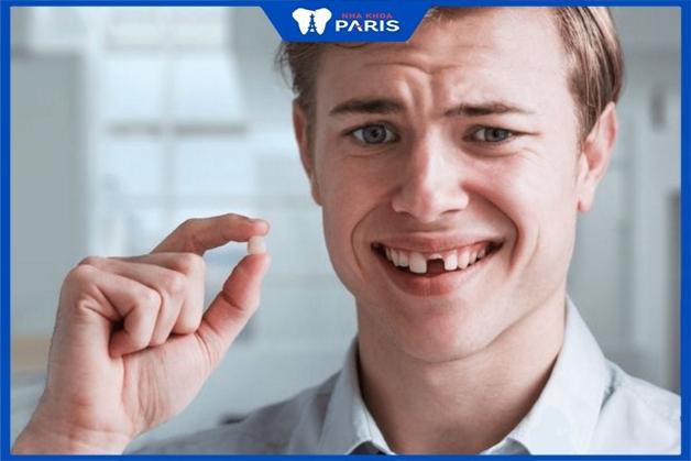 Răng cửa cần được nhổ bỏ khi bị gãy phần lớn thân răng