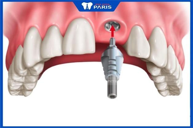 Trồng răng cửa bằng phương pháp cấy ghép Implant