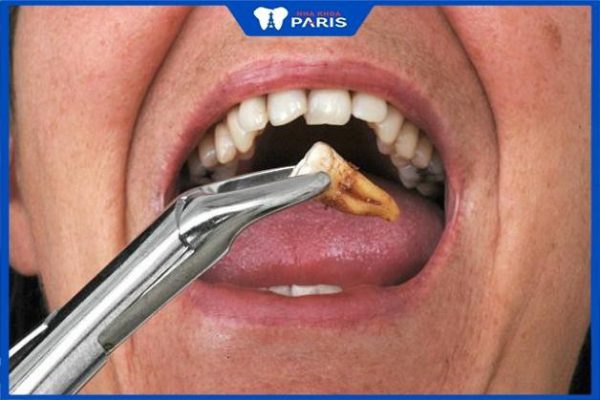 Nhổ răng hàm có ảnh hưởng gì không, 4 biến chứng có thể xảy ra