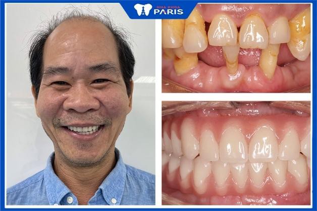 Những khách hàng sau khi làm răng tại Nha khoa Paris Quận 1