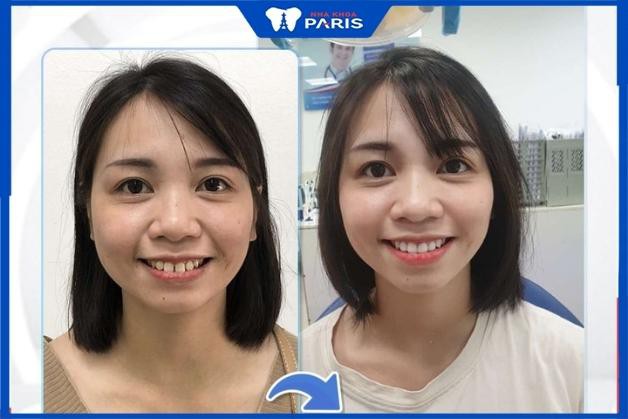 Những khách hàng sau khi làm răng tại Nha khoa Paris Quận 1