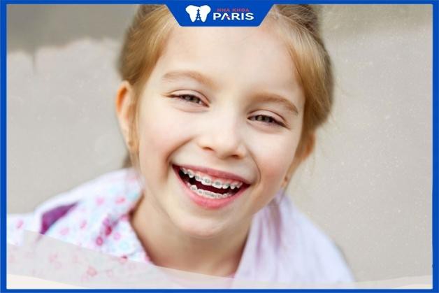 Niềng răng cho trẻ em có ảnh hưởng gì không - 3 phương pháp phổ biến
