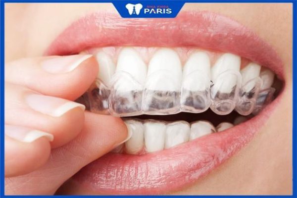 Niềng răng không mắc cài – phương pháp hiệu quả, thẩm mỹ cao