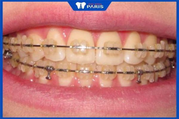 Niềng răng mắc cài sứ bị vàng: Nguyên nhân và cách hạn chế