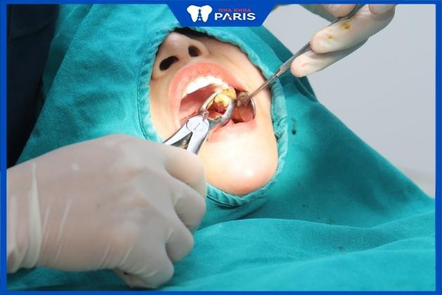 Quy trình nhổ răng khôn tại Nha khoa Paris Quận 3