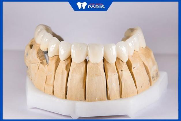 Răng sứ katana có mấy loại - Bác sĩ Vũ Đình Công Nha khoa Paris trả lời