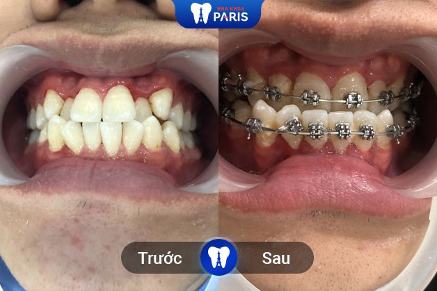 Review thực tế của khách hàng làm răng tại Nha khoa Paris quận Tân Bình