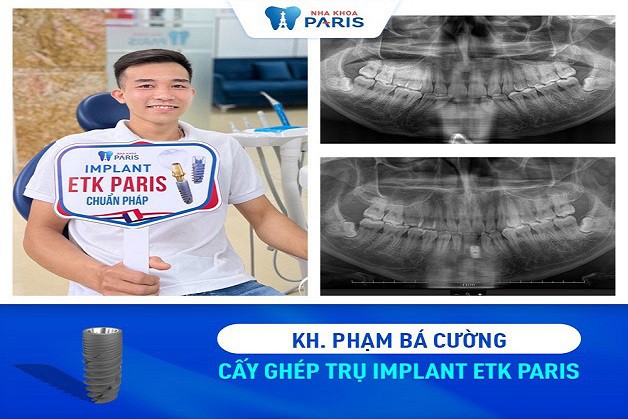 Review thực tế của khách hàng làm răng tại Nha khoa Paris quận Tân Bình