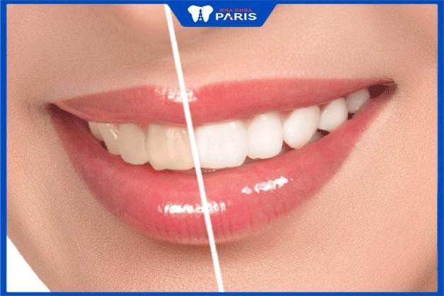 Công nghệ WhiteMax giúp răng trắng bật tone ngay sau khi thực hiện