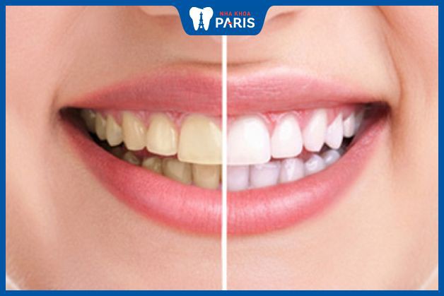 Tẩy trắng răng không gây hại răng nếu như thực hiện đúng cách