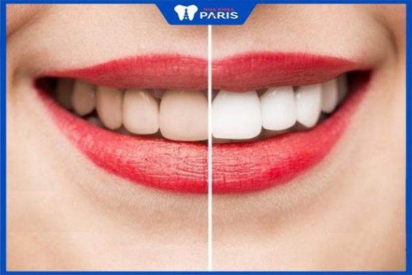 Tẩy trắng răng có hại răng không – 3 phương pháp phổ biến
