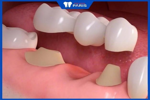 Cầu răng sứ có hình dáng và màu sắc tương tự răng thật