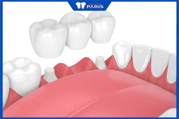 Trồng răng bắc cầu mất bao lâu – 5 ưu điểm nổi bật