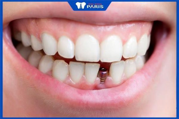 Trồng răng cửa có đau không, 3 Phương pháp trồng răng hiệu quả