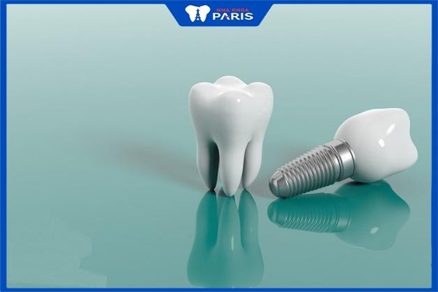 3 lý do khiến trồng răng Implant bền hơn so với các phương pháp khác