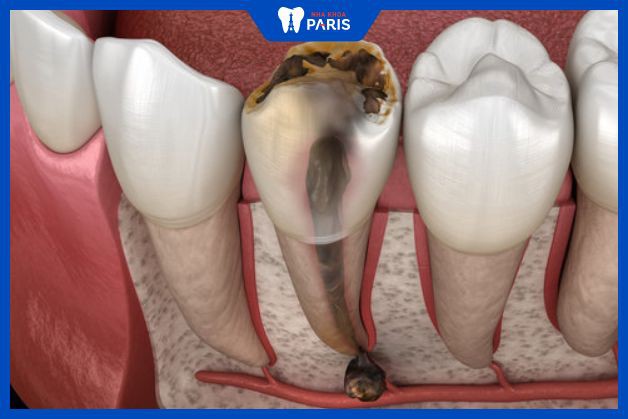 Răng bị viêm tủy nặng cần phải nhổ