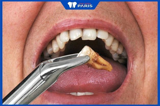 Khách hàng nhổ răng khôn mọc ngầm dưới nướu tại Nha Khoa Paris