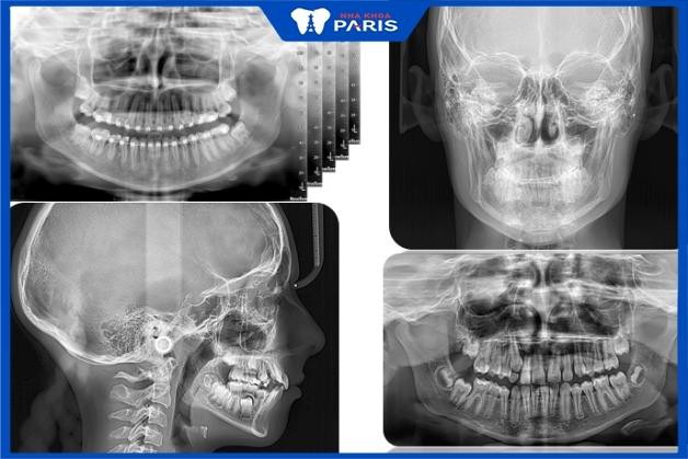 Các phương pháp chụp X quang răng phổ biến tại Nha Khoa Paris Đà Nẵng