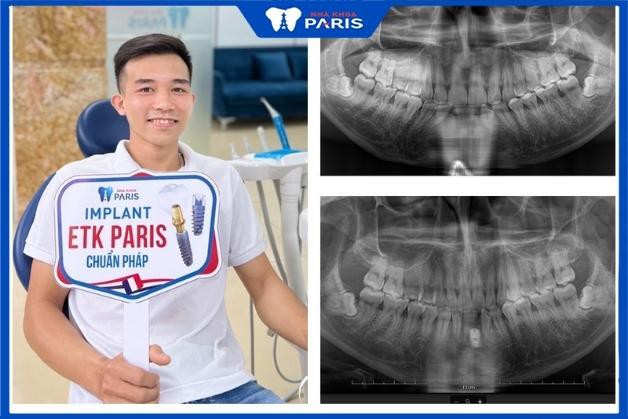 Cảm nhận khách hàng sau khi trồng răng Implant tại Nha Khoa Paris