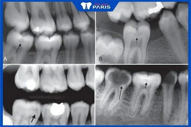Chụp X quang răng cận chóp