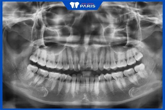 Chụp X quang răng ghi lại rõ nét các hình ảnh trong khoang miệng