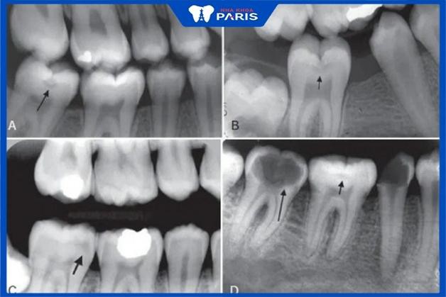 Chụp X quang răng cận chóp
