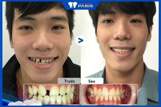 Khách hàng niềng răng thành công tại Nha Khoa Paris