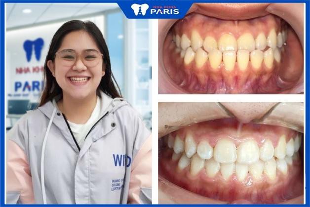 Kết quả của khách hàng sau khi niềng răng tại Nha Khoa Paris 