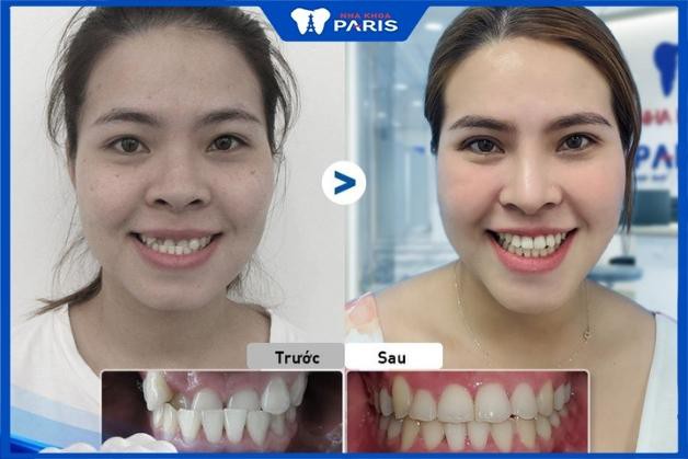 Kết quả của khách hàng sau khi niềng răng tại Nha Khoa Paris 