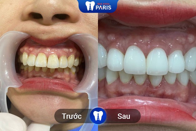 Kết quả làm răng của khách hàng tại Nha Khoa Paris chi nhánh Buôn Ma Thuột