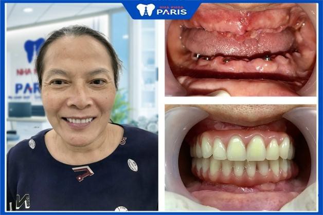 Kết quả làm răng của khách hàng tại Nha Khoa Paris Thủ Dầu Một