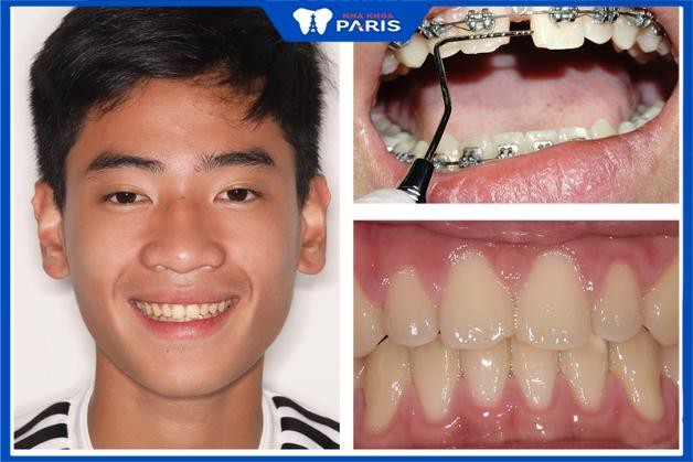 Kết quả làm răng của khách hàng tại Nha Khoa Paris Thủ Dầu Một