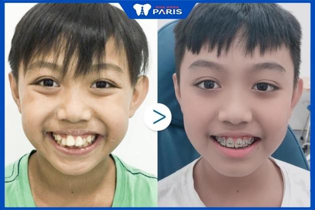 Kết quả niềng răng hô của khách hàng tại Nha Khoa Paris