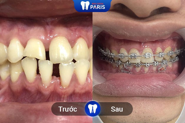 Kết quả trước và sau niềng răng mắc cài tại Nha Khoa Paris Buôn Ma Thuột