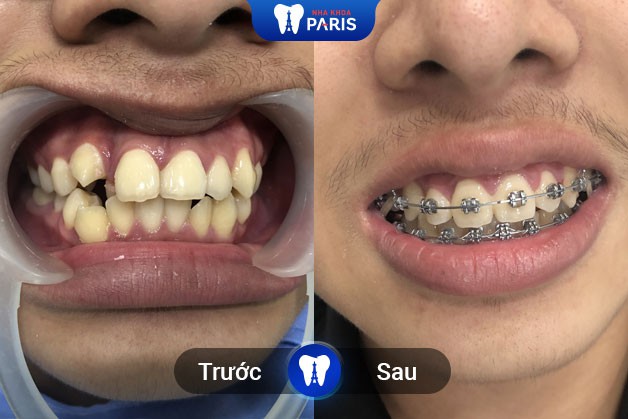 Khách hàng trước và sau khi niềng răng mắc cài tại Nha Khoa Paris Buôn Ma Thuột