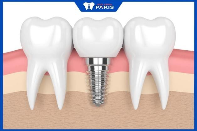 Khắc phục mất răng số 7 bằng trồng răng Implant