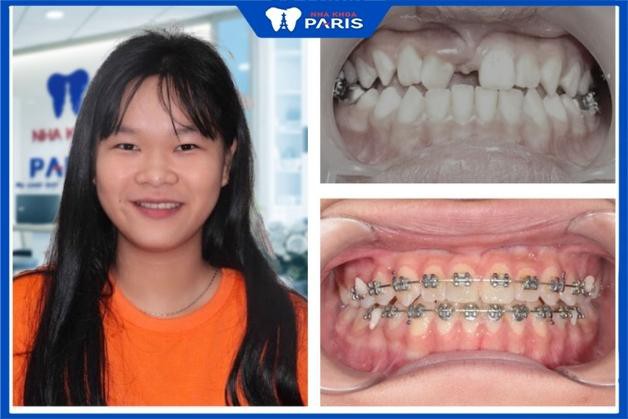 Khách hàng niềng răng tại Nha Khoa Paris Thủ Dầu Một