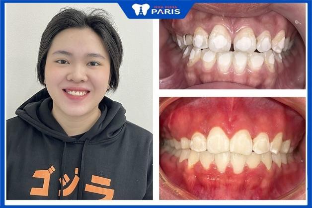 Khách hàng niềng răng tại Nha Khoa Paris