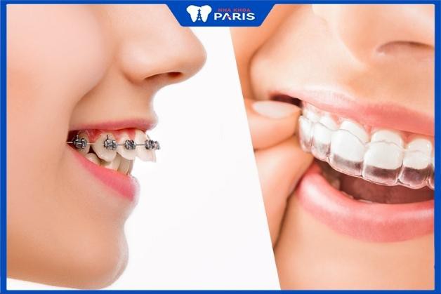 Nha Khoa Paris đang cung cấp nhiều phương pháp niềng răng khác nhau