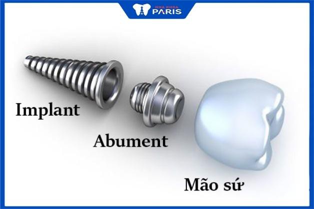 Răng Implant gồm có 3 bộ phận chính