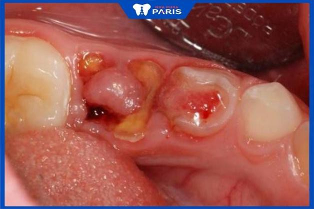 Biến chứng viêm huyệt ổ răng sau khi nhổ răng