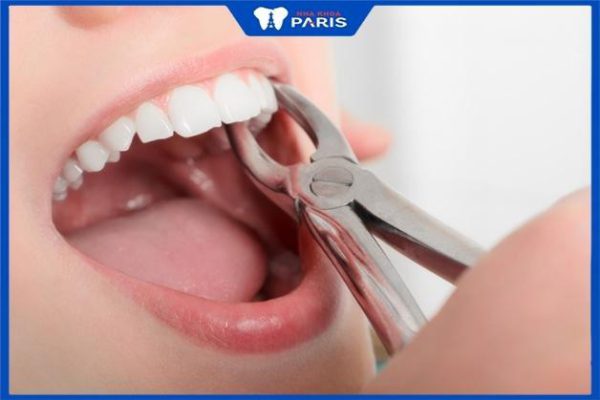 Nhổ răng: Những trường hợp nào bắt buộc phải nhổ răng