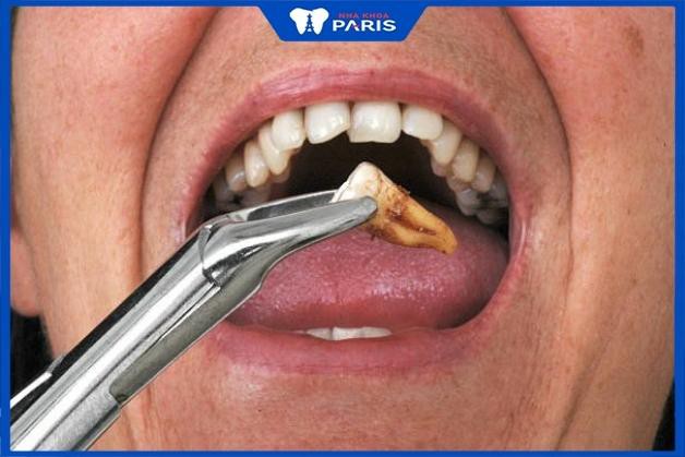 Nhổ răng cấm hàm trên có nguy hiểm gì không