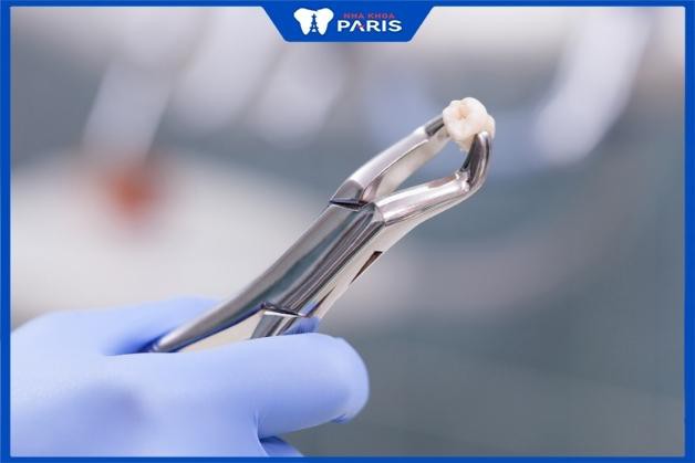 Nhổ răng số 7 có phải trồng lại không - Bác sĩ Ngô Quang Tín tại nha khoa Paris trả lời