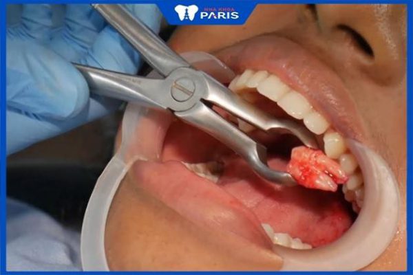 Nhổ răng số 7 có phải trồng lại không – Những hậu quả cần biết