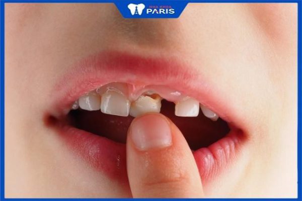 Nhổ răng sữa chưa lung lay có đau không? Trình tự thay răng ở trẻ