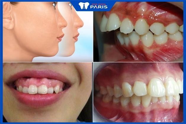 Niềng răng hô hàm trên giá bao nhiêu phụ thuộc tình trạng răng miệng