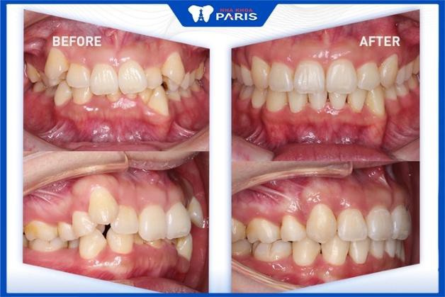 Tình trạng răng khấp khểnh được khắc phục hoàn toàn sau khi niềng răng khay trong